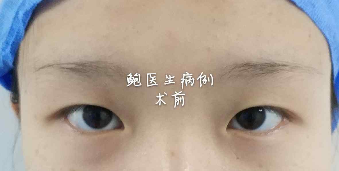 双眼皮手术后恢复期 双眼皮手术恢复时间文章配图