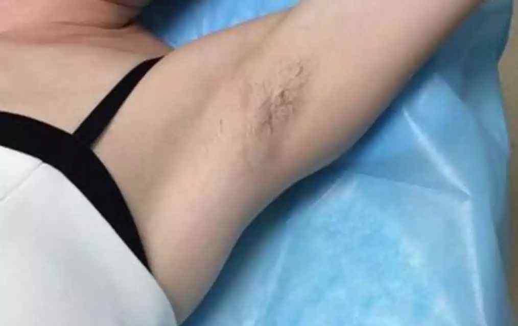 腋毛脱毛 科普篇|腋毛如何去除？文章配图
