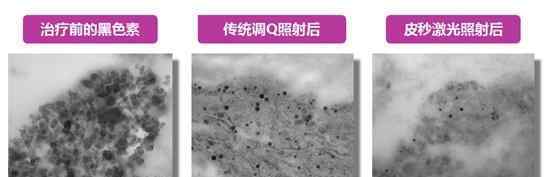 优化皮肤的“八个度”！你不了解的Picoway超皮秒