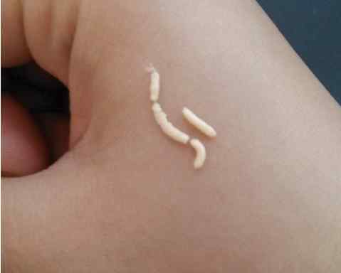 痘痘里面是什么 痘痘里面有什么?你一定不知道居然这么脏